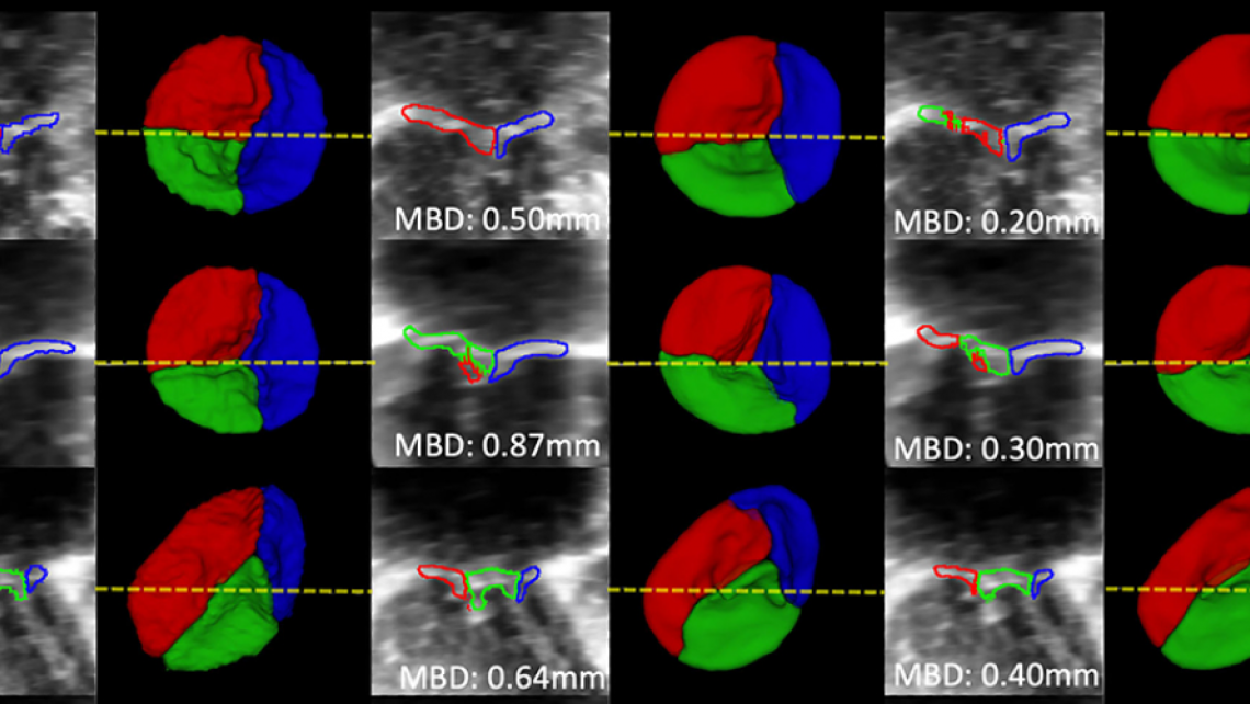 Using Deep Learning for Tricuspid Valve Segmentation in HLHS Patients ...